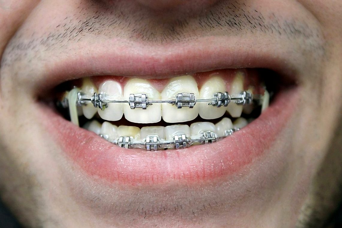 Металлические брекеты на зубах